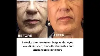 Thermage FLX treatment testimonial-Sugar Land, TX Medical Spa