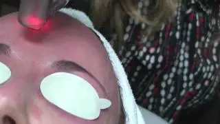 Fraxel Laser re:store for Face