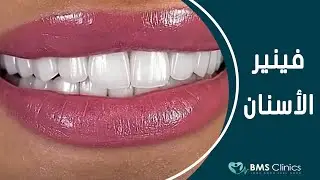 فينير الأسنان في مشفى بي أم اس كلينك اسطنبول تركيا - BMS Clinic - E max veneers