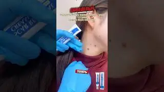 Крем для быстрого снятия паппилом