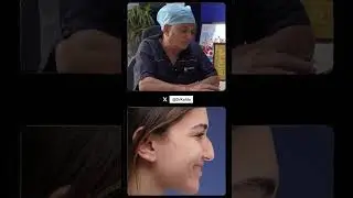 Rhinoplasty Results In Raipur 👃 | Dr. Kalda Explains Key Factors & Post-Surgery Impact 🏥✨
