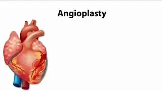 Angioplasty|#sciencefacts #angioplasty #didyouknowscience #satisfying #factbuster #scienceknowledge