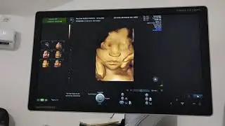 Voluson S10 3D/4D HDLIVE