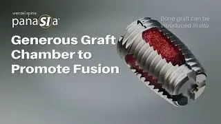 Wenzel Spine: panaSIa SI Fusion System