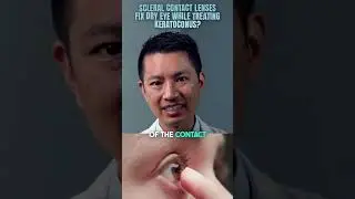 Why Patients Love Scleral Contact Lenses for Dry Eyes? Eye Doctor Explains #dryeyes