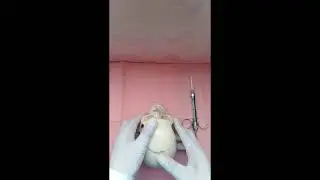 Anestesia Local de Nervios Incisivo y Mentoniano