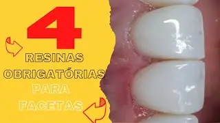 🛑4 RESINAS PARA FACETAS QUE NÃO PODEM FALTAR NO SEU KIT🤩🔥