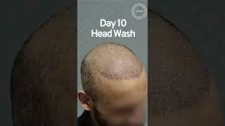 5000 grafts journey with DHI technique