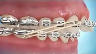 How to put on Class II Elastics
