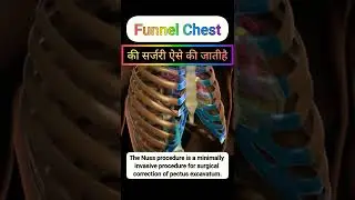 funnel chest की सर्जरी इतनी आसान होती है 😀 #shorts #funnelchest #pectusexcavatum