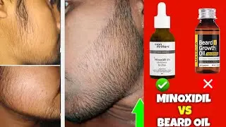 Minoxidil vs Beard Oil | Shocking Results You Need to See | minoxidil beard growth | beard growth 