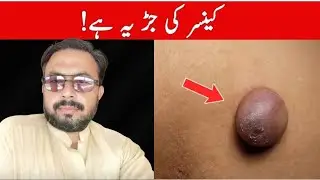 CANCER KO MAT BARHAEIN! | Cut off the Blood Supply to Cancer Cells & Anti Angiogenesi