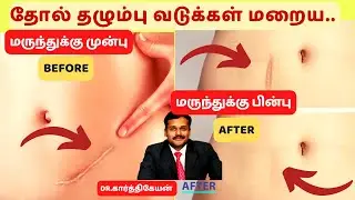 தோல் வடுக்கள் தழும்புகள் மறைய 6 டாக்டர் டிப்ஸ்|6 skin scar removal treatment in tamil|dr karthikeyan