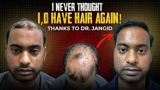Hair Transplant Success with Scarring Alopecia | My SkinQure Experience