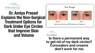 Under Eye Dark Circle Treatment Using Platelet-Rich Plasma and Hyaluronic Acid Fillers