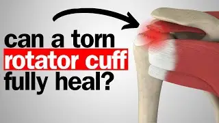 Does A Torn Rotator Cuff Ever Fully Heal?