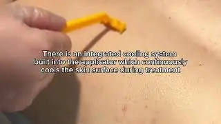 Mansculpt London - Step By Step Laser Hair Removal