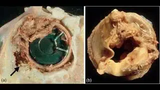 Infective Endocarditis (IE ) //  USMLE STEP 1 podcast
