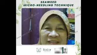 Roear Seaweed Micro-needling Technique (Kelantan)