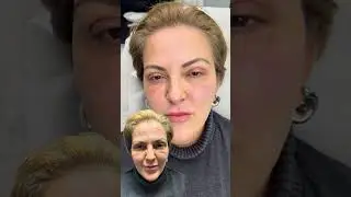 Liquid Facelift #liquidfacelift #botox #filler
