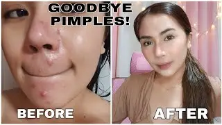SOLUSYON SA PIMPLES AND SCARS?! | UPDATED SKIN CARE ROUTINE