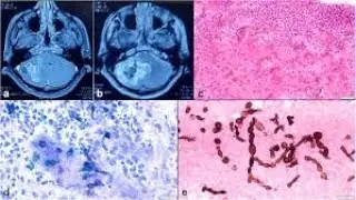 Phaeohyphomycosis Fungi Infection ; Causes, Clinical Syndrome, Diagnosis, Treatment