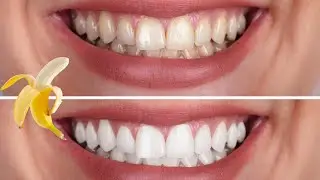 INCROYABLE ! Blanchissez vos Dents Naturellement avec une Peau de Banane 🍌✨