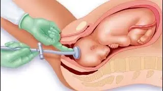 Vacuum Extraction In obstetrics Delivery/ vacuum assisted vaginal delivery technique used during CS