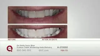 Go Smile Sonic Blue 5-Piece Teeth Whitening with Albany Irvin