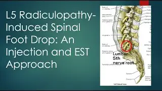 #2 L5 Radiculopathy-Induced Spinal Foot Drop: An Injection and EST Approach