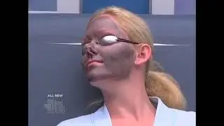Melasma and Hyperpigmentation scars treatment | Birthmark and tattoo removal with Spectra Laser