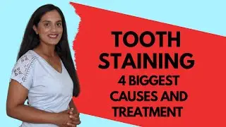 4 BIGGEST CAUSES OF TOOTH STAINING I Dentist's advice on causes and treatment of teeth stains
