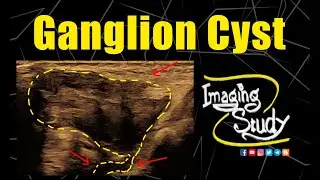 Ganglion Cyst - Pseudosolid Appearance | Wrist || Ultrasound || Case 324