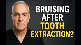 Bruising After Tooth Extraction: What&rsquo;s Normal and When to Call Your Dentist