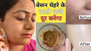  चेहरे के सारे काले दाग-धब्बे दूर करने के लिए इस तरह से लगाए बेसन आपकी त्वचा गोरी और चमकदार हो जाएगी