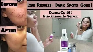 The DermaCo 10% Niacinamide Serum Review | Before & After Results