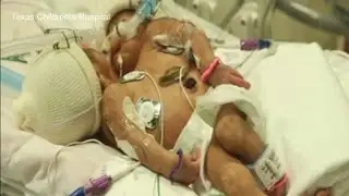 Conjoined twin girls to be separated in Texas