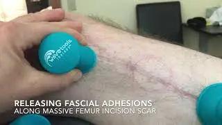 Cupping for scar tissue along incisions.