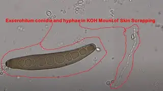 Exserohilum conidia and hyphae in KOH Mount of Skin Scrapping