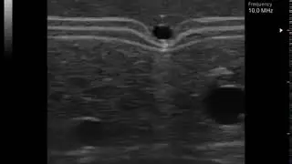 Transverse view of needle entering small vein