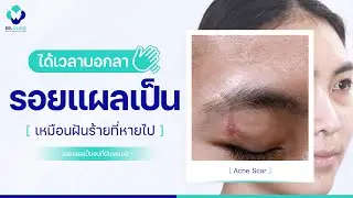 แผลเป็น | EP.12 | รอยแผลเป็น รักษาด้วยโปรแกรมเลเซอร์แผลเป็น ผิวดีขึ้นไหม? | BSL Clinic