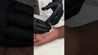 Botox for Sweaty Hands: The Ultimate Hyperhidrosis Solution!