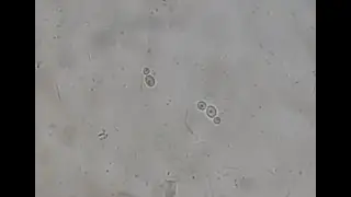 Yeasts, budding yeasts and hyphae in KOH mount of bile microscopy
