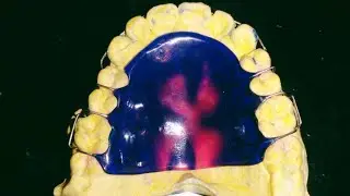 Removable Orthodontic Appliance Making By Haider || Orthodontic Retainer Appliance Making By Haider.