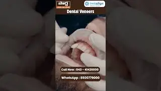 పర్ఫెక్ట్ స్మైల్ కోసం Veneers Treatment @ Partha Dental | Free Consultation & EMI Options