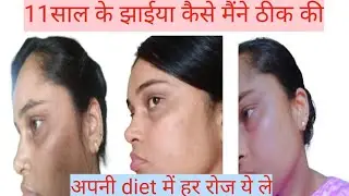Mere 11 Saal Ka Pigmentation Thik Hua | Aaj Se Hi Ye Sab Lena Shuru Karo | 