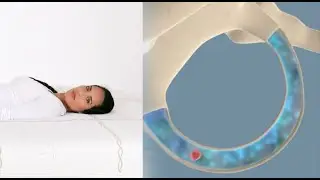 Maniobra de Lempert (BBQ) para tratar el vértigo postural paroxístico benigno