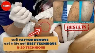Quick Tattoo removal in Delhi | Best Technique  | R-20 Technique | SkinQure