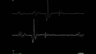 Motor unit with satellite potentials