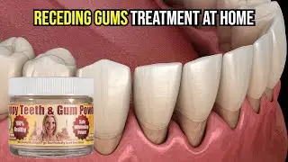 Gum Recession Treatment At Home | Revive Happy Teeth & Gum Powder Review